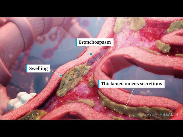 What Is Severe Asthma?