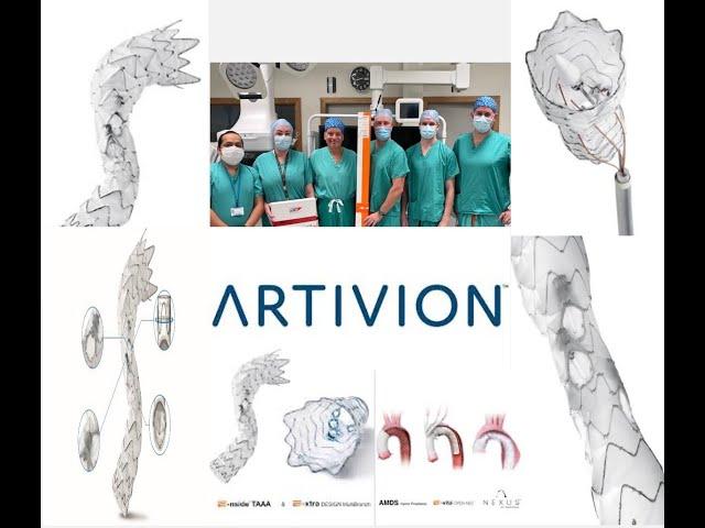 Launch of First Artivion-iBevar-E-nside TAAA Endograft  at Galway University Hospital, Ireland