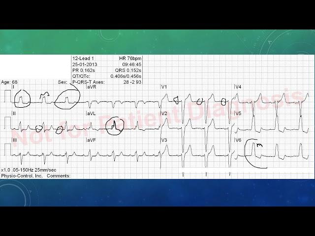 EKG befunden leicht gemacht, EKG Beispiele