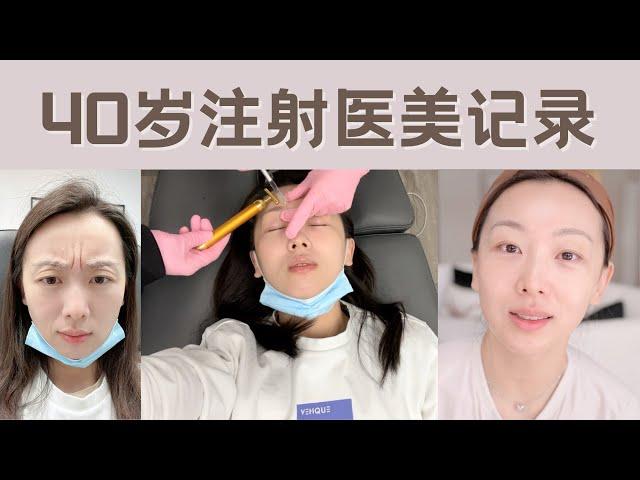 【Anna阿姨 医美记录】玻尿酸填充眼窝 肉毒Botox眉心川字纹 | 抗衰-注射类