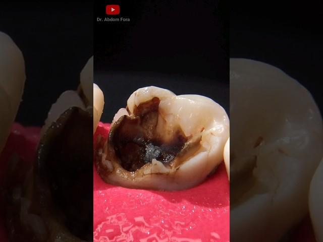 This cavity is too big!