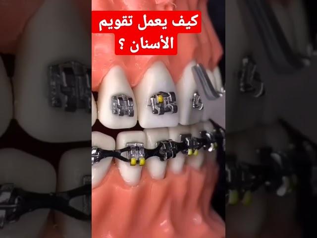 شاهد بنفسك كيف يعمل تقويم الأسنان بسرعة وبدون ألم ونتائج سحرية لا تصدق الحصول على ابتسامة جميلة