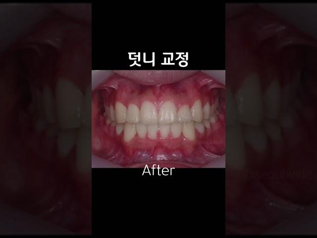 덧니 치아교정 전후 사진, 치료 과정 - 비발치 교정