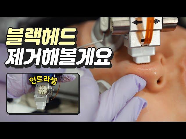 통증끝판왕 인트라셀 시술 보여드립니다 - 블랙해드 제거, 모공 인트라셀