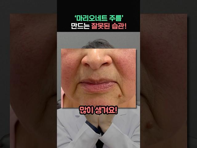 의사가 알려주는 ‘마리오네트 주름’ 없애는 가장 쉬운 방법은?