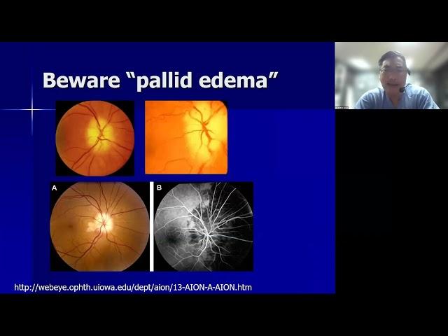 Lecture: Five Neuro-Ophthalmic Diagnoses You Cannot Afford to Miss