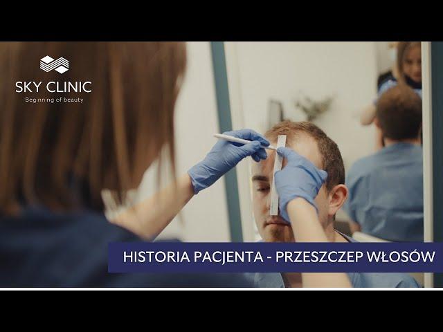 Przeszczep włosów w Sky Clinic - Cały proces krok po kroku