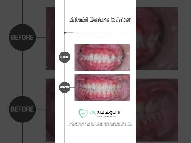 우리 아이에게 적절한 시기와 방법 찾아 성장기 치아교정 해주세요:)