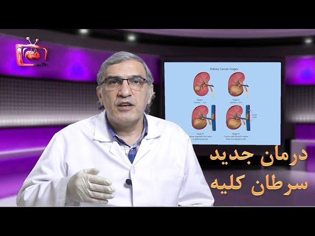 درمان جدید سرطان کلیه - دکتر حسن زاده