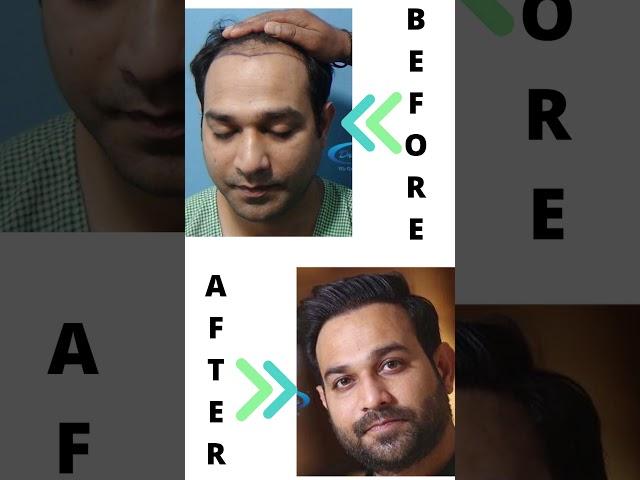 Best Hair Transplant Results with Before After Images | Total Grafts Implanted 5248 | After 2 years