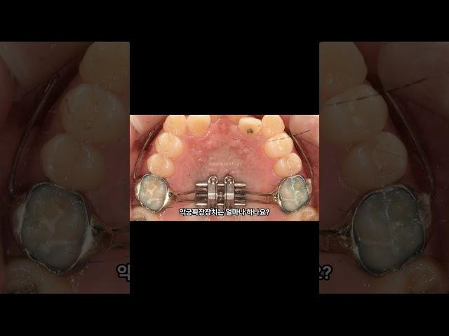 악궁확장장치는 얼마나 붙이고 있나요?
