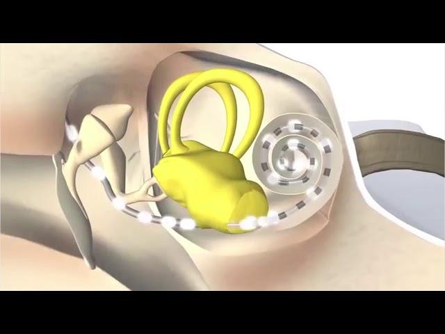 Как работает кохлеарный имплант
