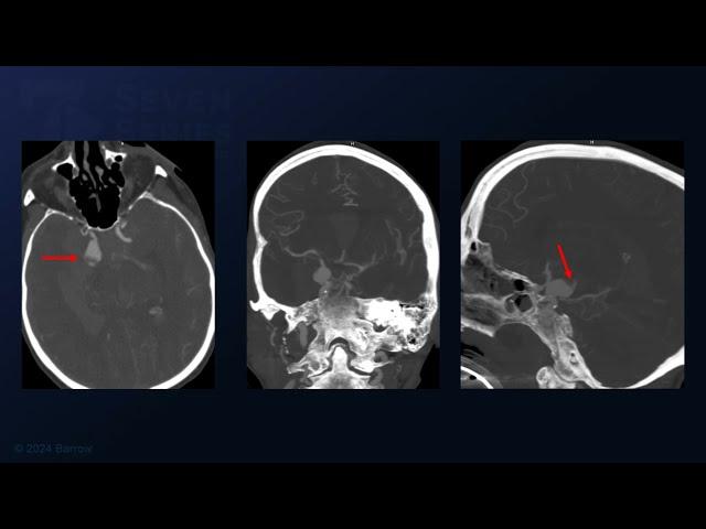 Pterional Craniotomy for Clipping of a Posterior Communicating Artery Aneurysm