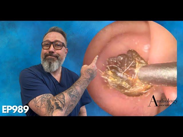 The MOST SATISFYING ring of dry ear wax removal!- EP989