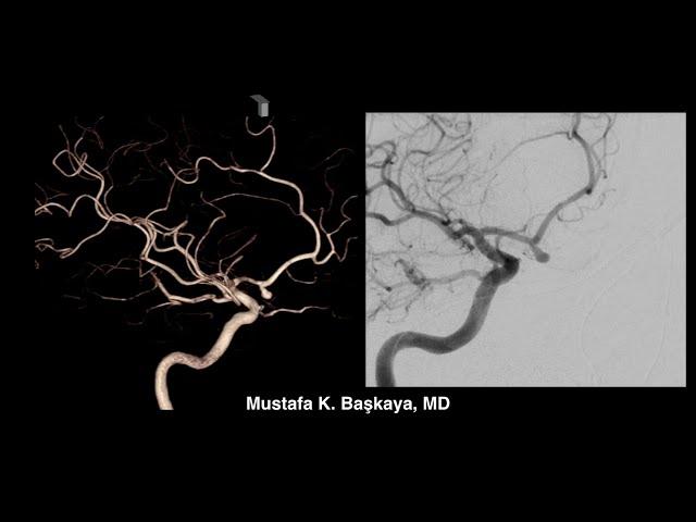 Microsurgical Clipping of Ruptured Anterior Communicating Artery (AComA) Aneurysm