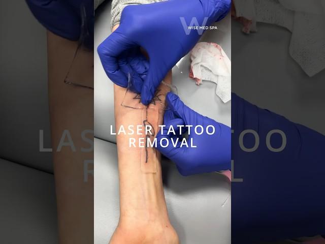 A PFD patch will maximize your Laser Tattoo Removal results at Wise Med Spa in Wayne, NJ!