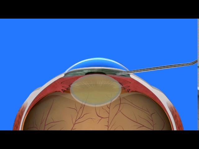 Cataract Surgery