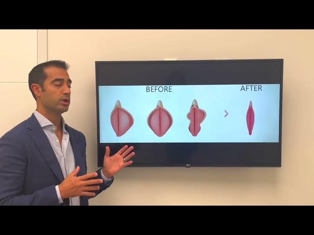 Labiaplasty with Dr. Zuri in Miami | Zuri Plastic Surgery