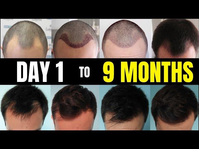 Evolution of Transplanted Hair, from Day 1 to 9 Months