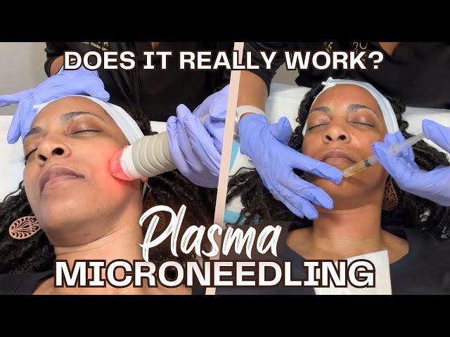 Full Process of my PRP Microneedling for the 1st Time | Will it work?