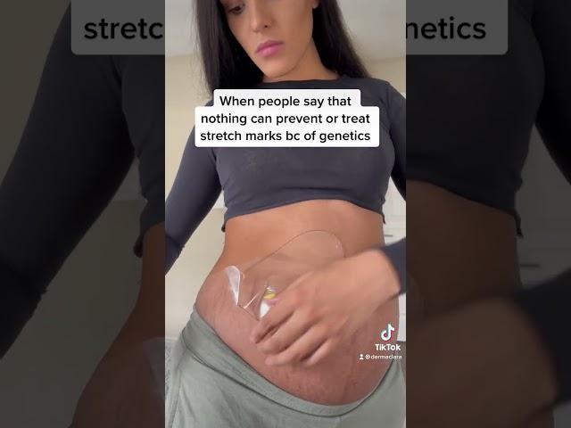 Clinically proven stretch mark treatment ️