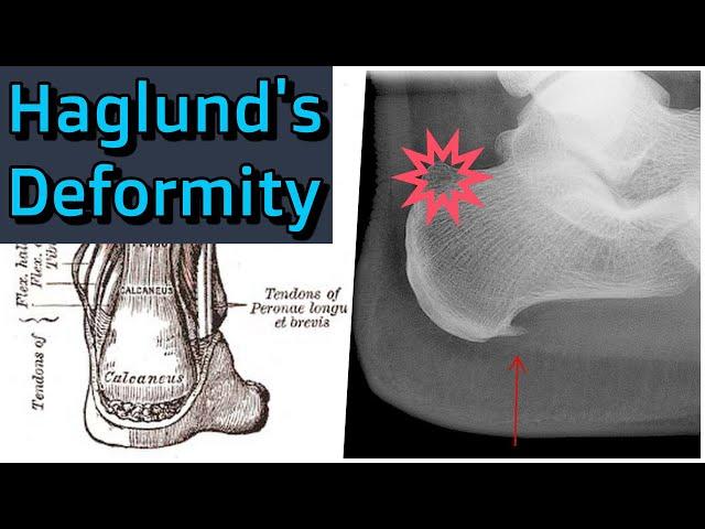 Haglund's Deformity