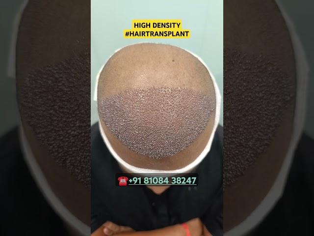 Hair Loss Treatment #hair #hairloss #hairlosstreatment #ytshorts #alopecia #hairtransplant #hairfall