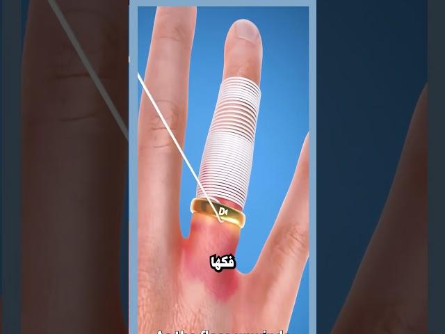 كيفية إزالة خاتم عالق  #قصص #قصص_واقعية #قصص_حقيقية #video #shorts #fyp #خاتم #يد #حلول_سريعة #viral