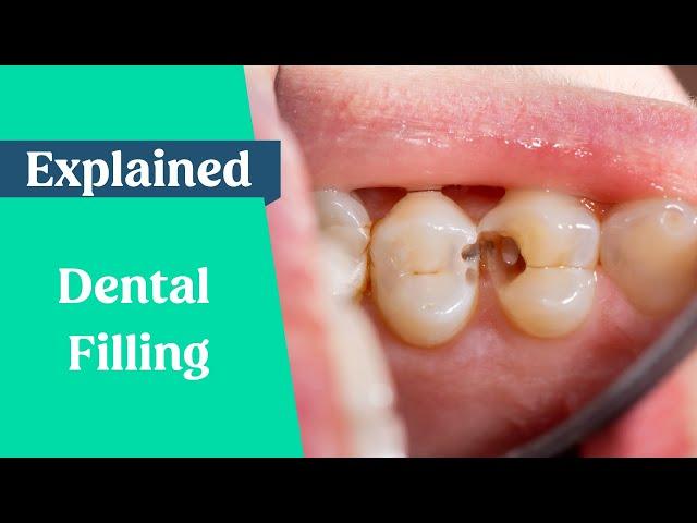 Dental Fillings Explained