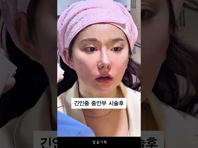 [얼굴기획] 긴인중 중안부축소는 양악시술