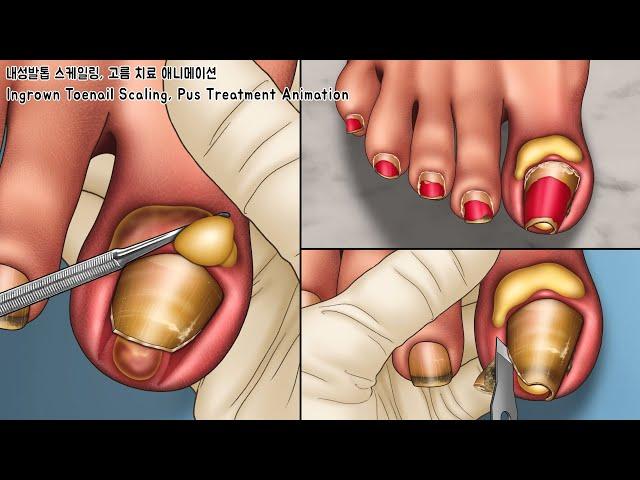 ASMR Cleanly Treat Old Ingrown Toenails and Pus! Toenails Scaling Animation | Deep Clean Treatment