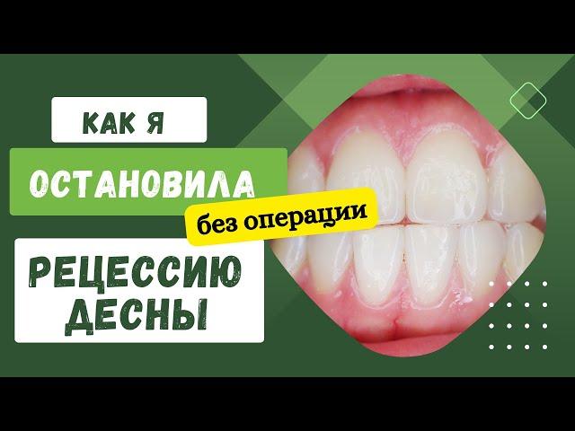 Как я остановила рецессию десны без операции. 4 минуты в день, и десны стали возвращаться на место