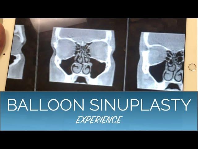 Balloon Sinuplasty, Septoplasty,  and Turbinate Reduction - EXPERIENCE and COST breakdown