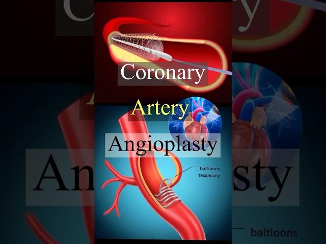 Revolutionary Heart procedure|Coronary artery angioplasty| #shorts #angioplasty #heartdisease #trend