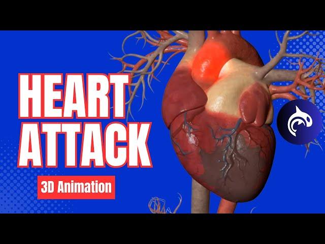 Heart Attack - Myocardial Infarction - 3D Animation