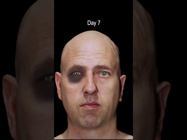 Black Eye Facial Trauma Time Lapse Healing. #blackeye #facialfracture #nasalfracture #brokennose