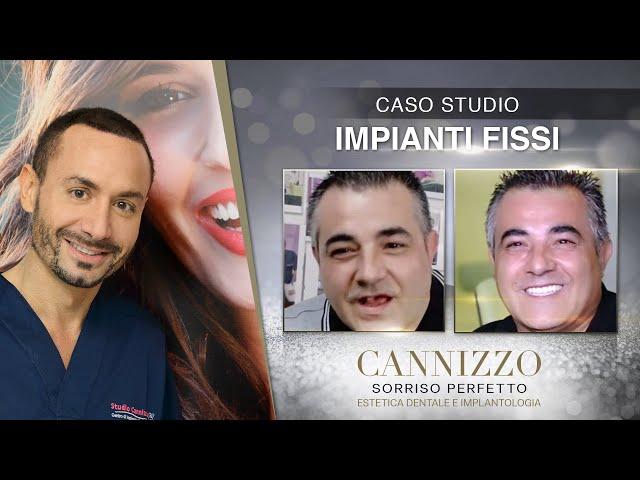 Implantologia Fissa Prima e Dopo - Studio Cannizzo