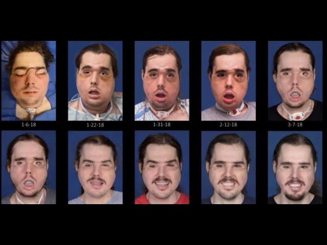 See the remarkable recovery progression of face transplant patient Cameron Underwood of Yuba City