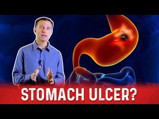 How To Get Rid Of Stomach Ulcer? – Dr.Berg On Peptic Ulcer Treatment