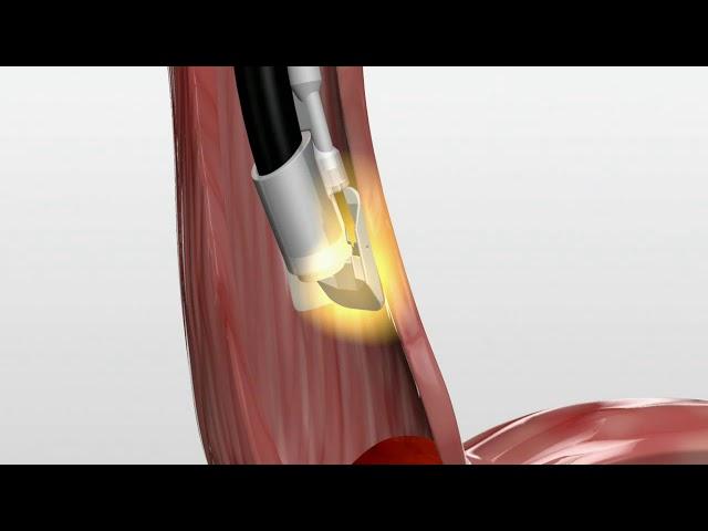 BARRX 90 - Endoskopska radiofrekventna ablacija Barrett-ovog jednjaka
