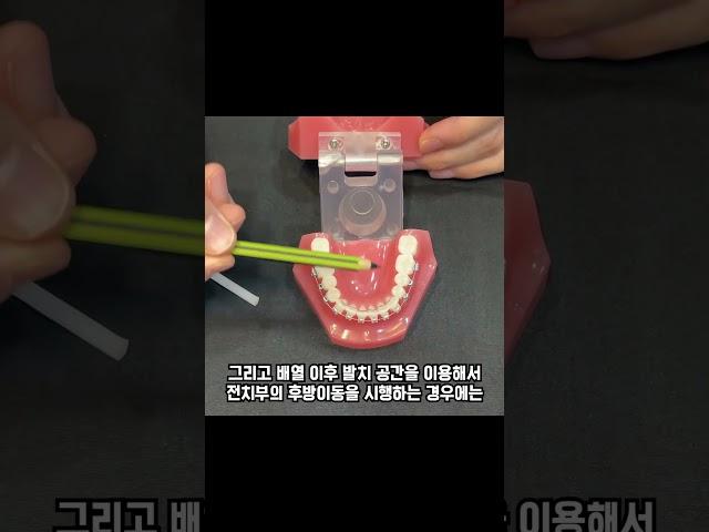 교정 와이어 찔림, 왁스 사용 방법 Feat. 교정과 전문의 김철순 원장님 #인비절라인 #교정전문의 #교정치과 #교정치료