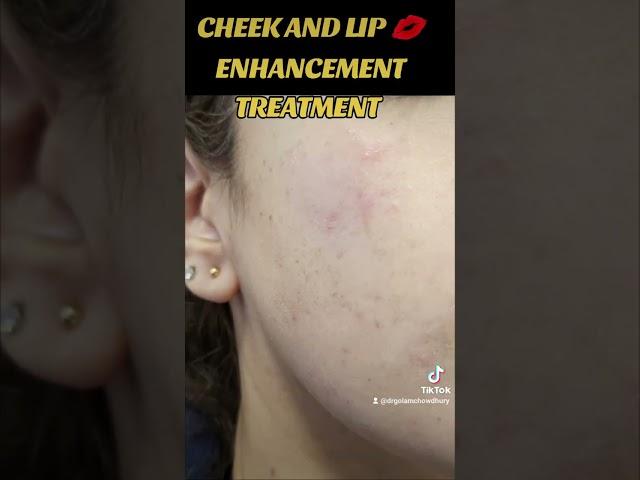 Cheek and lip  Enhancement Treatment with Dermal filler.  ( BEFORE AND AFTER)