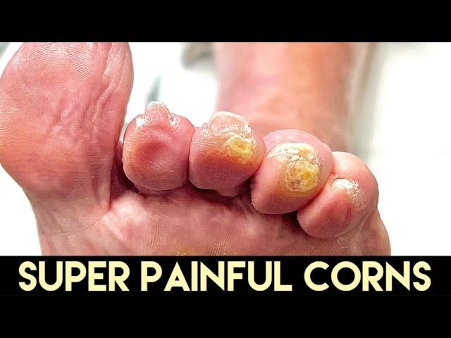 SUPER RELAXING DEBRIDEMENT OF MULTIPLE TOE CORNS ** BRING THE PILLOW