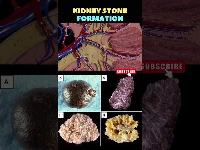 Kidney Stone formation Animation | Kidney stone removal | Kidney disease