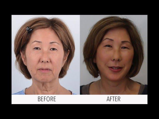 Face Lift Surgery