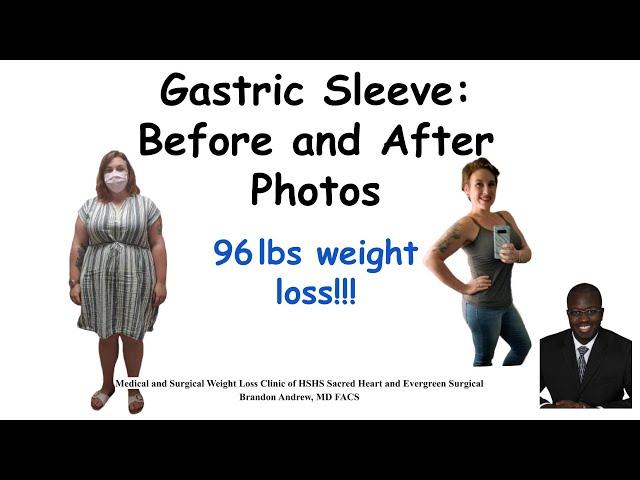 Gastric Sleeve Before and After Pictures and Results | Bariatric Weight Loss Surgery Journey Results