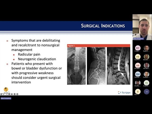 Degenerative Spondylolisthesis presented by Michael Pompliano, MD San Diego Spine Foundation