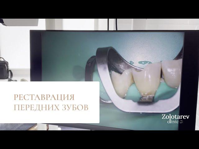 Реставрация зубов