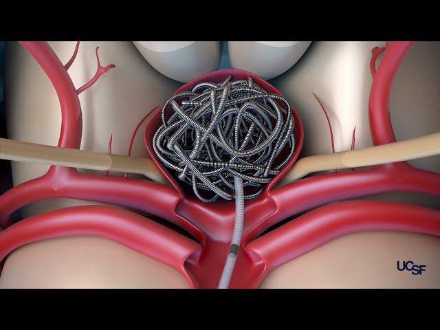 Surgical Treatment Options for Brain Aneurysms | Ethan Winkler, MD, PhD