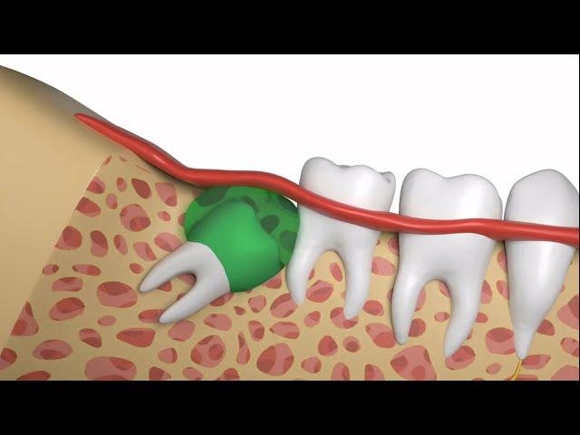 How To Safely and Quickly Have a Wisdom Tooth Extraction